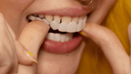 Snap-On Smile Veneers Customizable Instant Teeth Cover Natural Color Reusable Dental Appliance