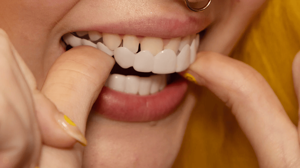 Snap-On Smile Veneers Customizable Instant Teeth Cover Natural Color Reusable Dental Appliance