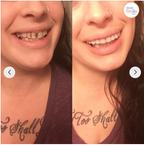 Snap-In Dental Prosthesis Snap-On Dentures Flexible Fit for Missing, Crooked, or Discolored Teeth