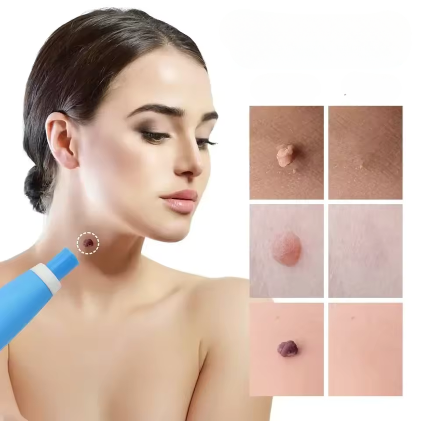WartAway Natural Wart Remover Silicone Bands 40-Pack Pain-Free Scar-Free Treatment