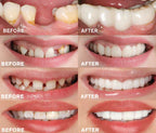 Snap-In Dental Prosthesis Snap-On Dentures Flexible Fit for Missing, Crooked, or Discolored Teeth