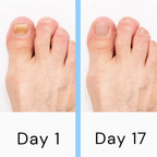 Nail Laser Fungus Treatment Device Portable Handheld USB Rechargeable FDA-Cleared for Toenail and Fingernail Fungus